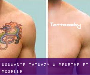 Usuwanie tatuaży w Meurthe et Moselle