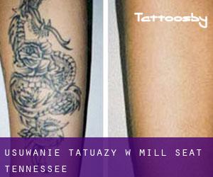 Usuwanie tatuaży w Mill Seat (Tennessee)