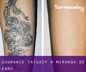 Usuwanie tatuaży w Miranda de Ebro