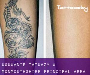Usuwanie tatuaży w Monmouthshire principal area
