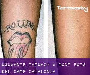 Usuwanie tatuaży w Mont-roig del Camp (Catalonia)