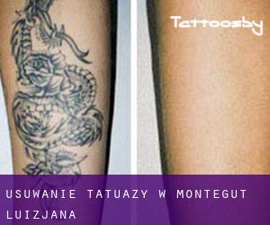 Usuwanie tatuaży w Montegut (Luizjana)