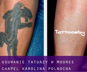 Usuwanie tatuaży w Moores Chapel (Karolina Północna)