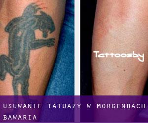 Usuwanie tatuaży w Morgenbach (Bawaria)