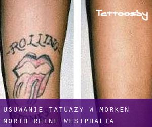 Usuwanie tatuaży w Morken (North Rhine-Westphalia)