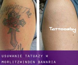 Usuwanie tatuaży w Morlitzwinden (Bawaria)
