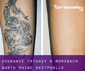 Usuwanie tatuaży w Morsbach (North Rhine-Westphalia)