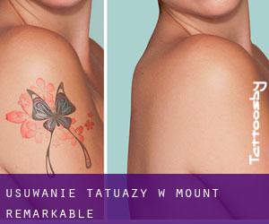 Usuwanie tatuaży w Mount Remarkable