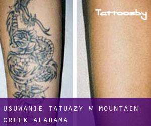 Usuwanie tatuaży w Mountain Creek (Alabama)