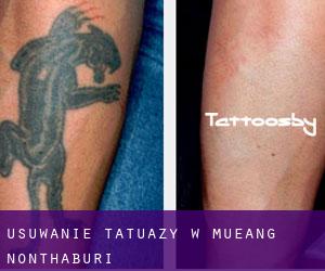 Usuwanie tatuaży w Mueang Nonthaburi