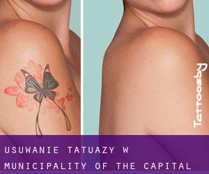 Usuwanie tatuaży w Municipality of the Capital