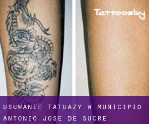 Usuwanie tatuaży w Municipio Antonio José de Sucre
