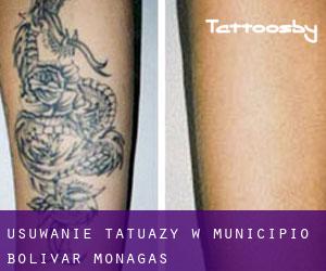 Usuwanie tatuaży w Municipio Bolívar (Monagas)