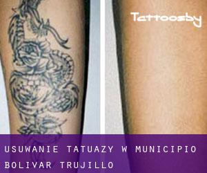 Usuwanie tatuaży w Municipio Bolívar (Trujillo)