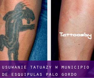 Usuwanie tatuaży w Municipio de Esquipulas Palo Gordo