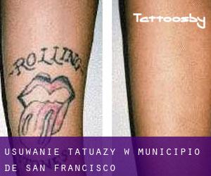 Usuwanie tatuaży w Municipio de San Francisco