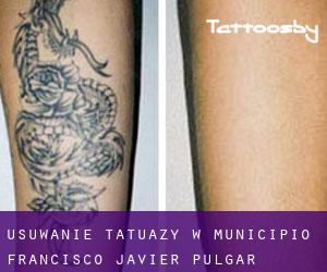 Usuwanie tatuaży w Municipio Francisco Javier Pulgar