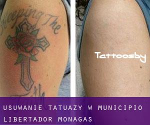 Usuwanie tatuaży w Municipio Libertador (Monagas)
