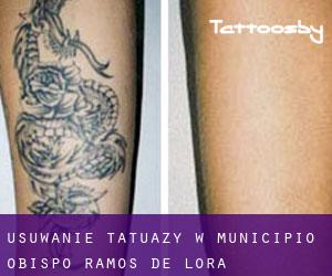 Usuwanie tatuaży w Municipio Obispo Ramos de Lora