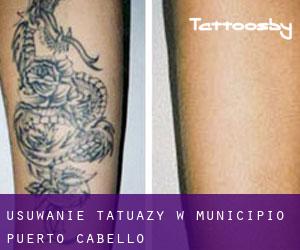 Usuwanie tatuaży w Municipio Puerto Cabello