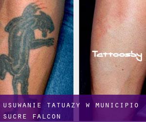 Usuwanie tatuaży w Municipio Sucre (Falcón)