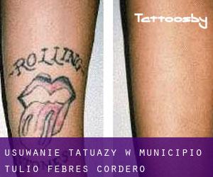 Usuwanie tatuaży w Municipio Tulio Febres Cordero