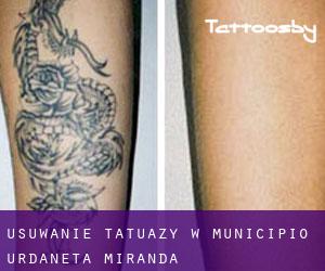 Usuwanie tatuaży w Municipio Urdaneta (Miranda)