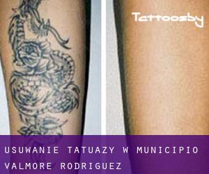 Usuwanie tatuaży w Municipio Valmore Rodríguez