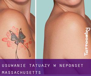 Usuwanie tatuaży w Neponset (Massachusetts)
