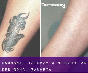 Usuwanie tatuaży w Neuburg an der Donau (Bawaria)