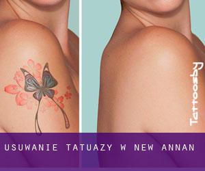 Usuwanie tatuaży w New Annan