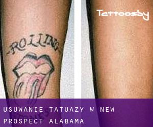 Usuwanie tatuaży w New Prospect (Alabama)