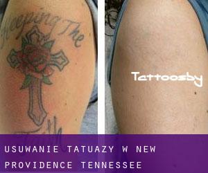 Usuwanie tatuaży w New Providence (Tennessee)