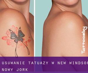 Usuwanie tatuaży w New Windsor (Nowy Jork)