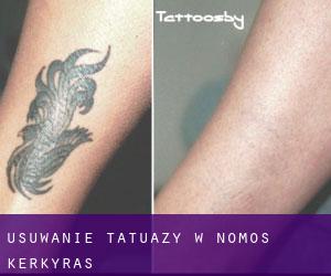 Usuwanie tatuaży w Nomós Kerkýras