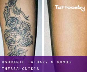 Usuwanie tatuaży w Nomós Thessaloníkis
