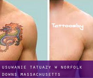 Usuwanie tatuaży w Norfolk Downs (Massachusetts)