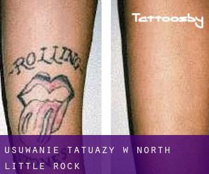 Usuwanie tatuaży w North Little Rock