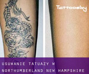 Usuwanie tatuaży w Northumberland (New Hampshire)
