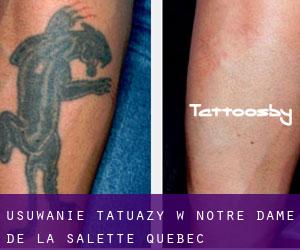 Usuwanie tatuaży w Notre-Dame-de-la-Salette (Quebec)
