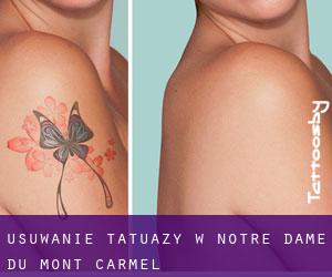 Usuwanie tatuaży w Notre-Dame-du-Mont-Carmel
