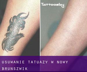 Usuwanie tatuaży w Nowy Brunszwik