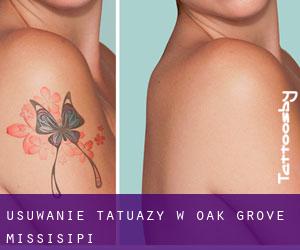 Usuwanie tatuaży w Oak Grove (Missisipi)