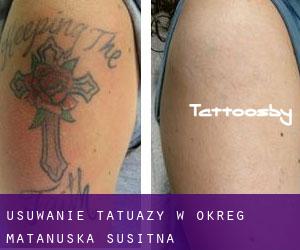 Usuwanie tatuaży w Okreg Matanuska-Susitna