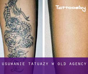 Usuwanie tatuaży w Old Agency
