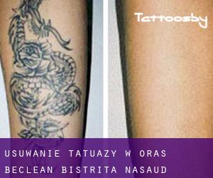 Usuwanie tatuaży w Oraş Beclean (Bistriţa-Năsăud)