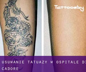 Usuwanie tatuaży w Ospitale di Cadore