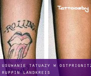 Usuwanie tatuaży w Ostprignitz-Ruppin Landkreis