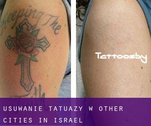 Usuwanie tatuaży w Other Cities in Israel