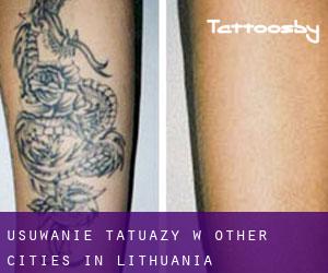 Usuwanie tatuaży w Other Cities in Lithuania